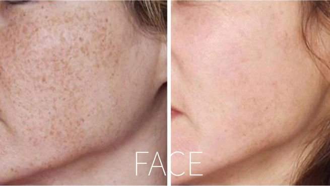 Banish Brown Spots